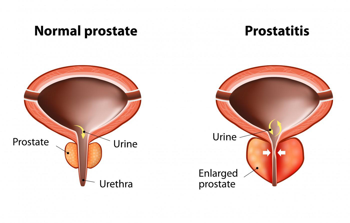 Нормальная простата здорового мужчины и воспаление предстательной железы при простатите